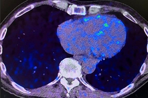 Heart PET scans from a study participant