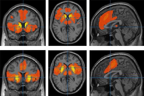 Brain images with red and yellow areas.