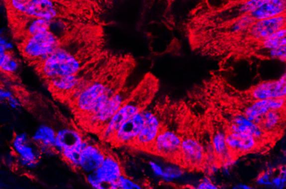Microscope image of abnormal pancreatic ducts.