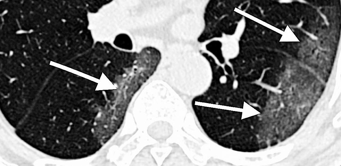 CT scan of lungs of COVID-19 patient with areas described by radiologists as resembling grains of ground glass.RSNA
