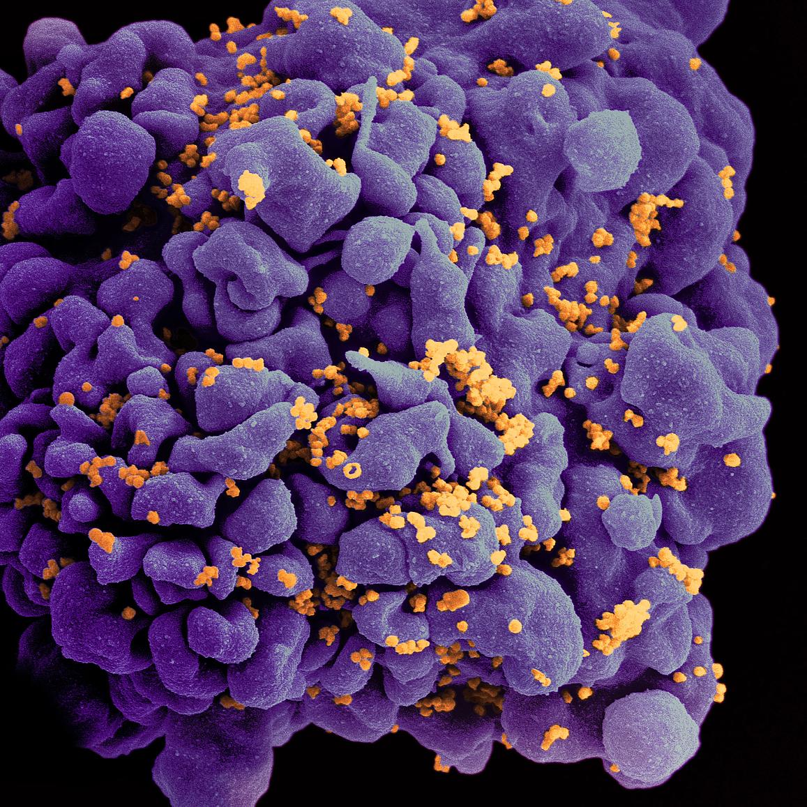 Combined anti-HIV antibody infusions suppress virus for prolonged period