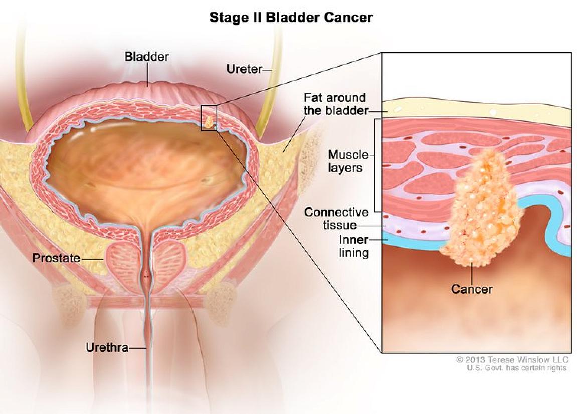 Immunotherapy After Surgery Helps People with High-Risk Bladder Cancer Live Cancer-Free Longer