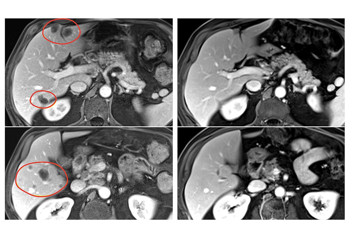 Combination immunotherapy shrank a variety of metastatic gastrointestinal cancers