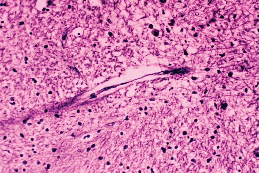 Microscopic image of an Alzheimer’s brain with neurofibrillary tangles in the cerebellum.