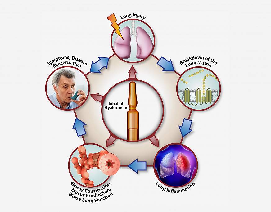 Illustration of COPD cycle