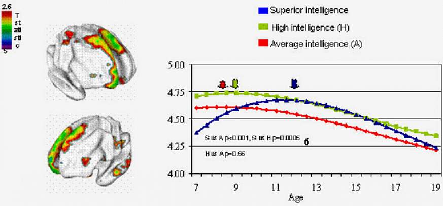 The developmental trajectory of waxing and waning in cortex thickness differs as the brain matures in different IQ groups. Thickness of the area at the top/front/center, highlighted in MRI brain maps at left, peaks relatively late, at age 12 (blue arrow),