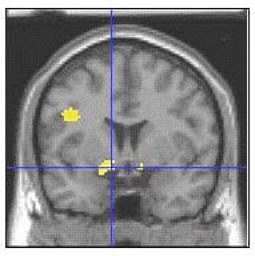 amygdala 
