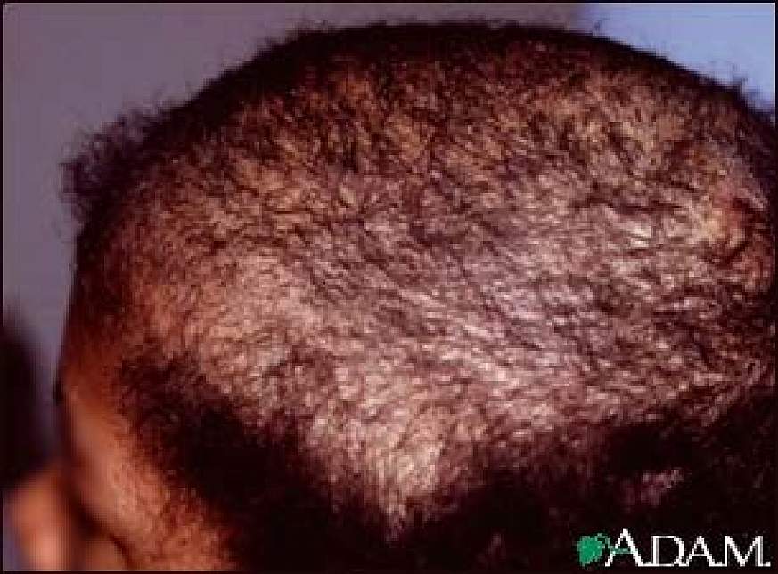 Human head with a bald patch.