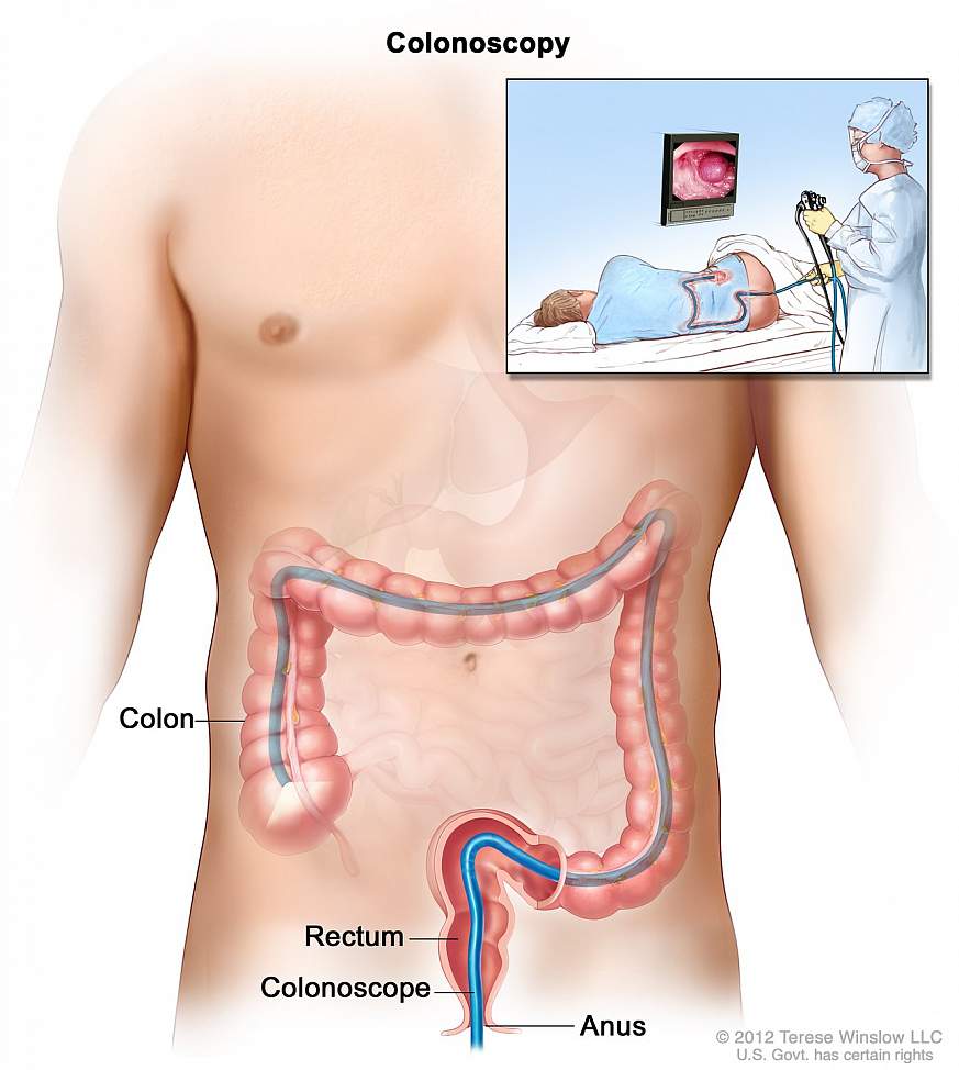 Artistic rendition of a colonoscopy 