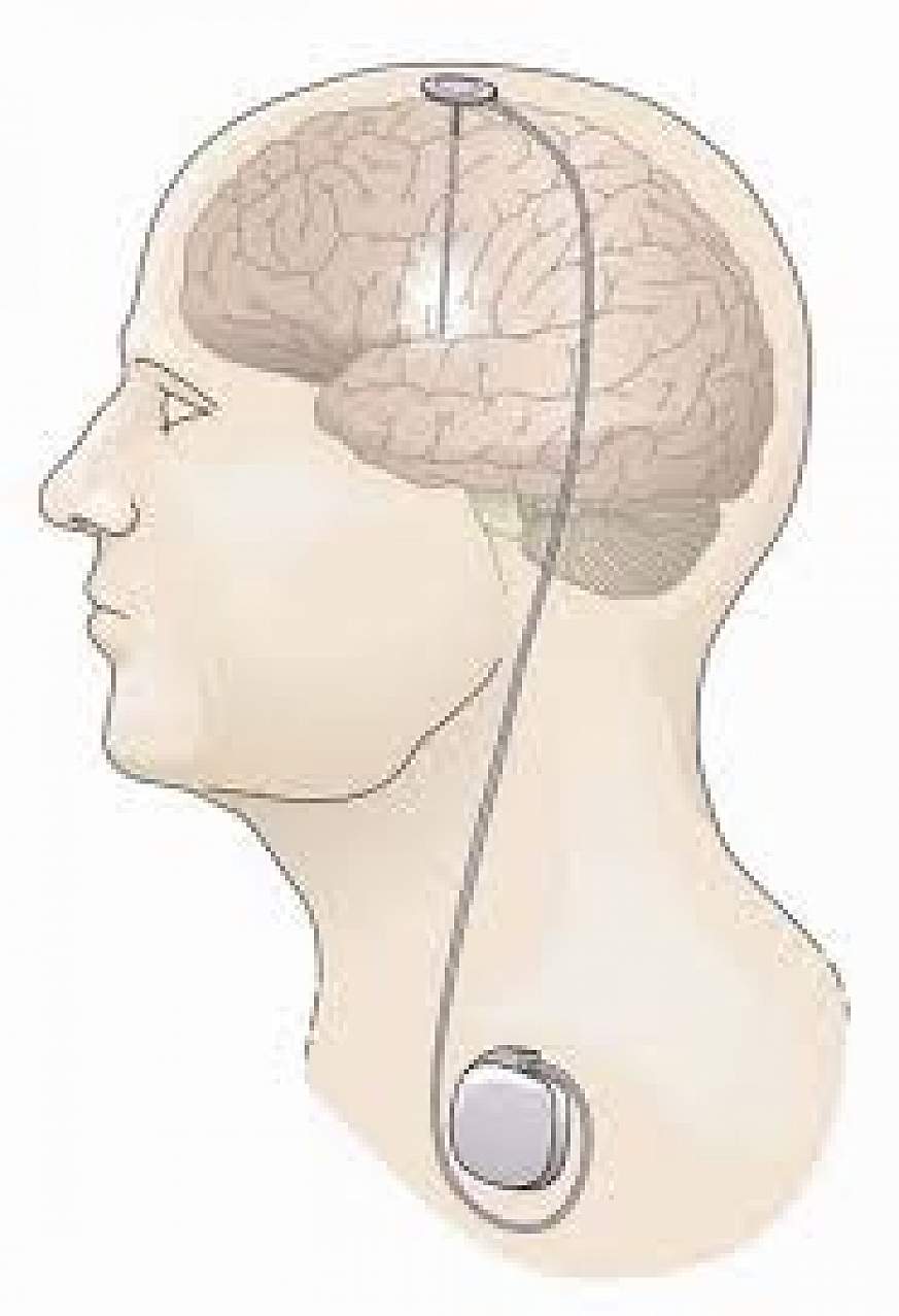 Illustration of DBS for Parkinson's disease