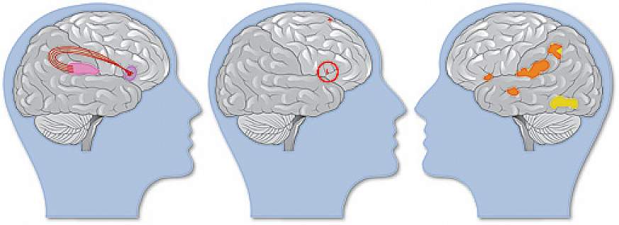 Brains compensating for dyslexia vs. brain of a typical reader