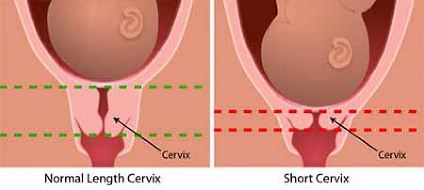 Diagram depicting a normal size cervix and a short cervix