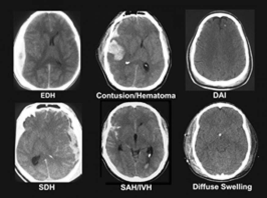 photo of CT scans show differences among six types of traumatic brain injury