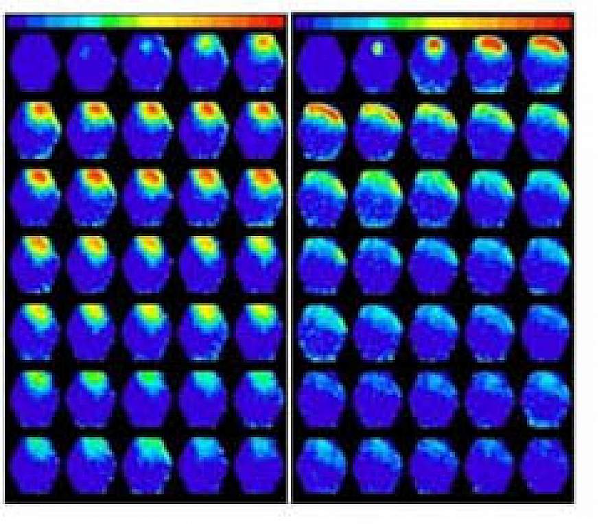 abnormal brain activity spreading from a tumor in mouse brain tissue after electrical stimulation.