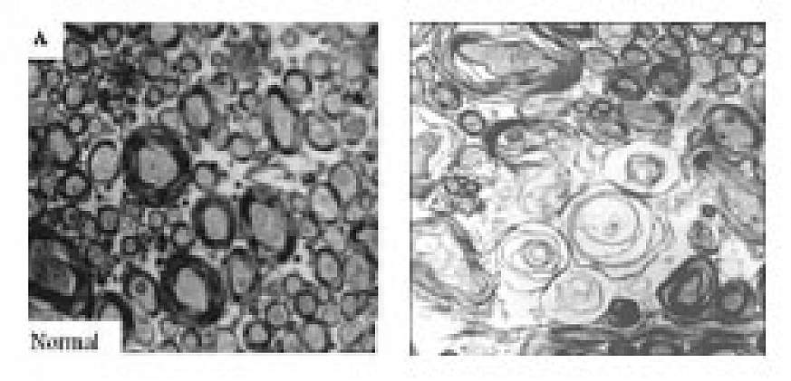 Left: Normal corpus collosum axon. Right: Abnormal corpus collosum axon.