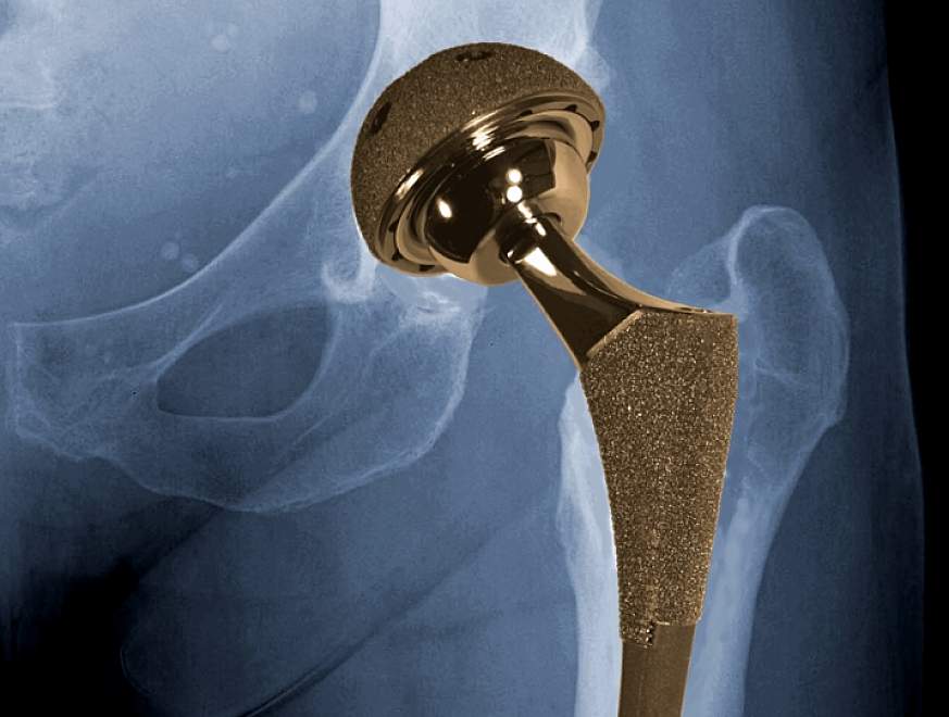 Graphic of hip showing metal-on-metal implant.