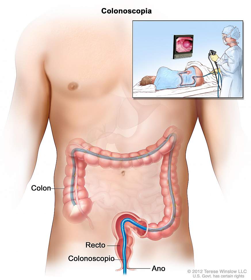 Image shows sigmoidoscope insertion.