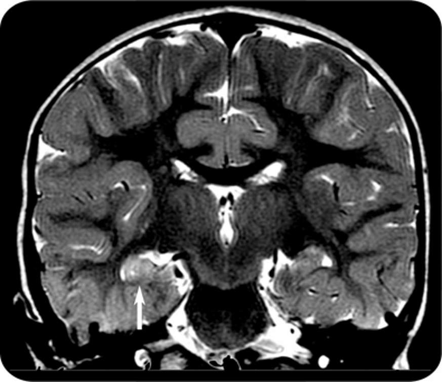 MRI scan of a child within 72 hours of febrile status epilepticus.