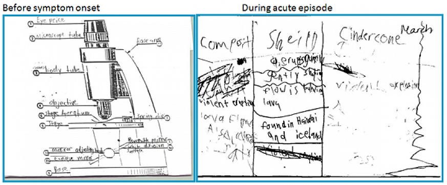 Child’s drawing before and during acute episode.