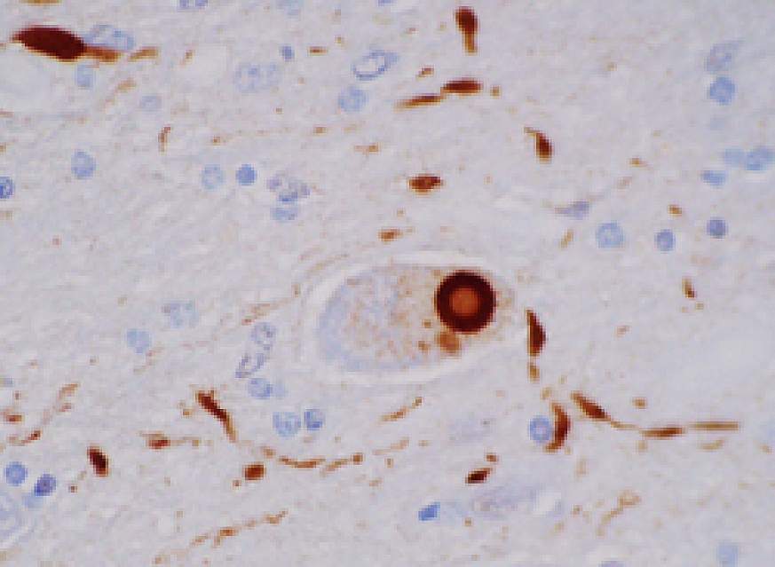 A Lewy body in brain tissue