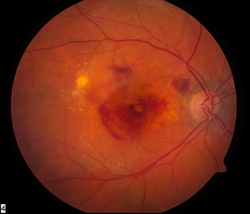 Photo of eye with neovascular AMD