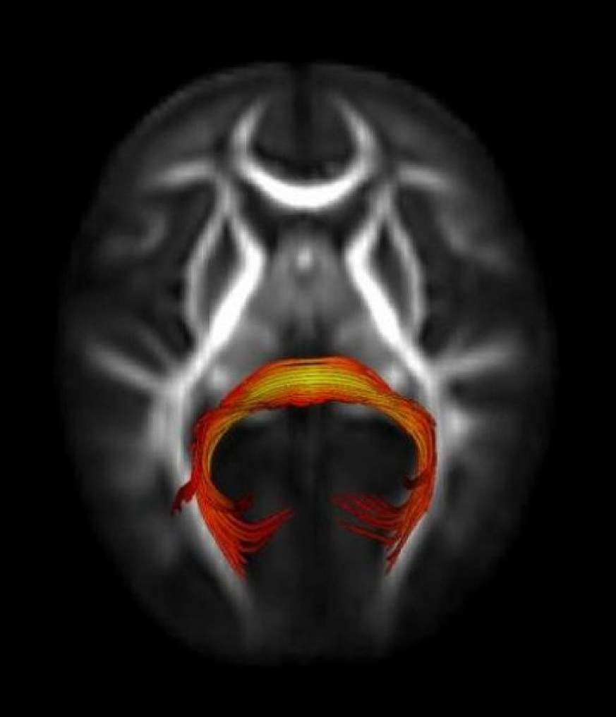 Image of brain structure known as the splenium of the corpus callosum