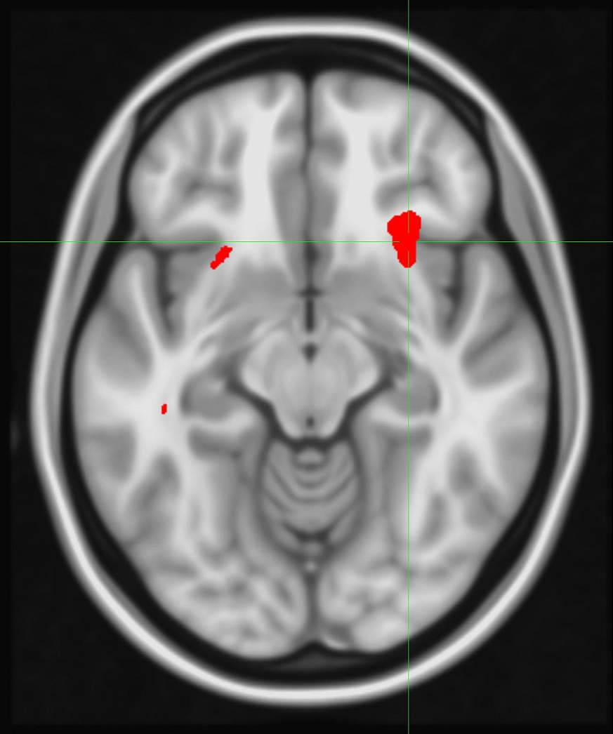  Image of brain scan used in the study