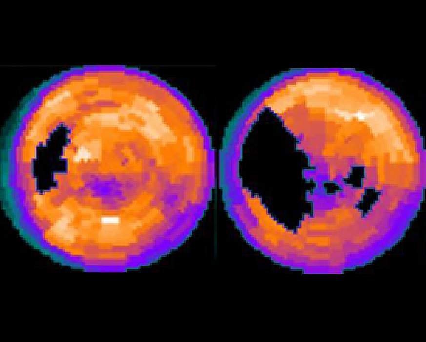 Computer image of two heart scans