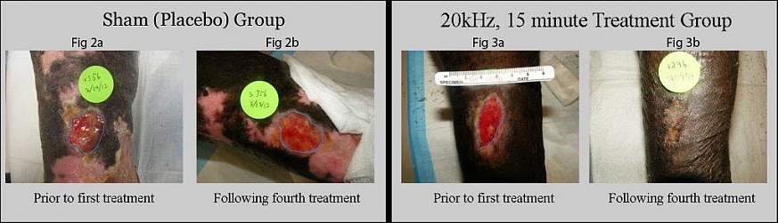 Image of difference in wound healing using ultrasound patch