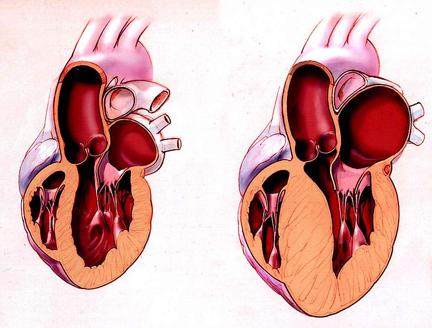 Diagram of a normal and affected heart