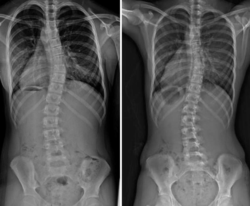 mild scoliosis x ray