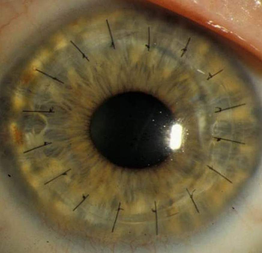 Photo of an eye after a traditional cornea transplant.