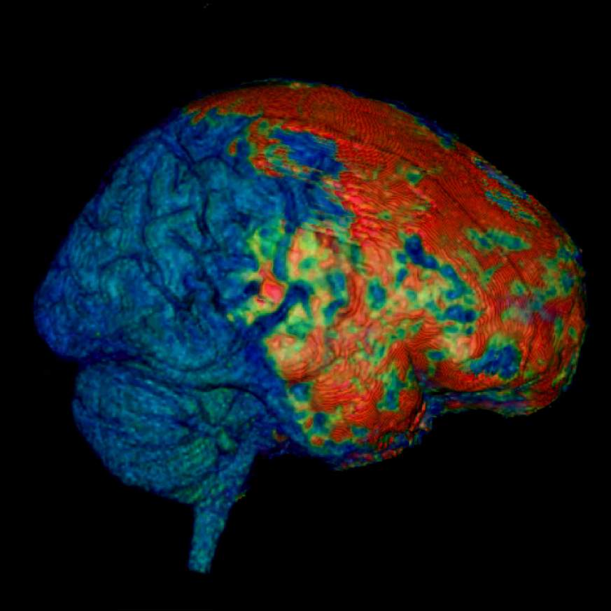 Image showing effects of concussion on the human brain