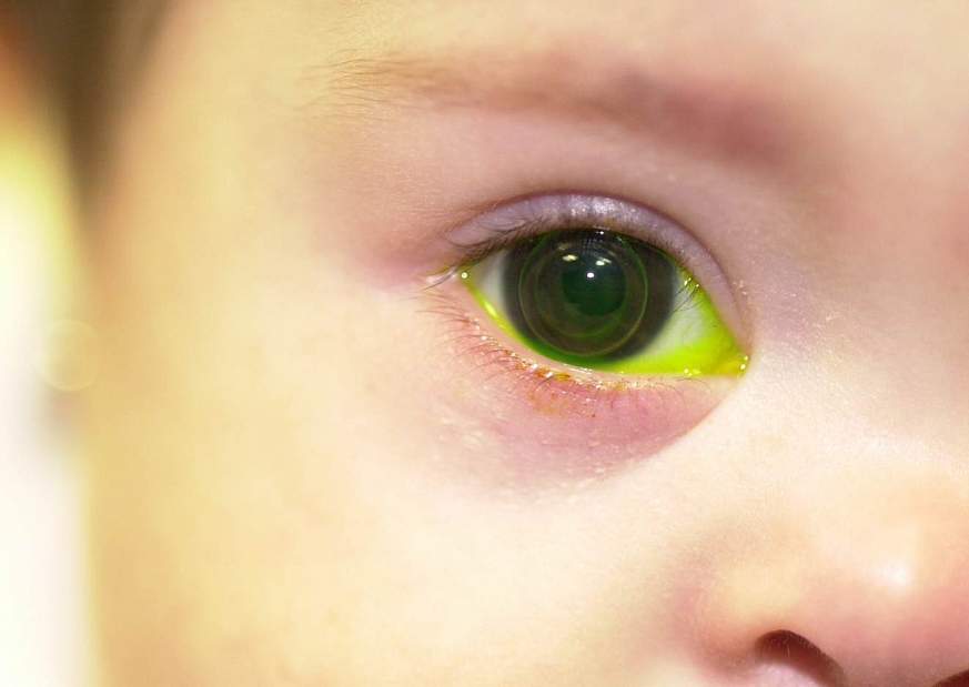 Child's eye with fluorescent green dye.