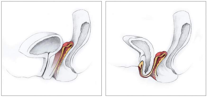 Pelvic organ prolapse.