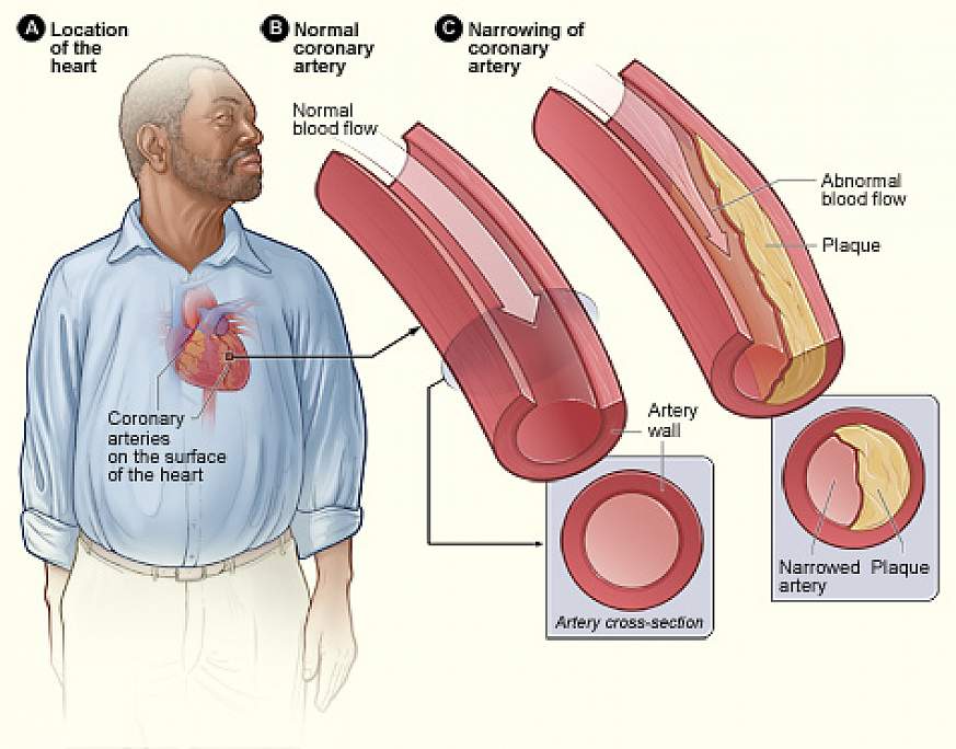 Plaque buildup in arteries.