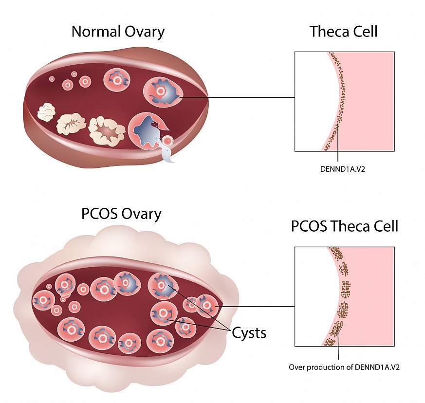 Illustration of PCOS in an ovary.