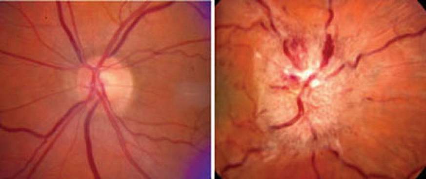 Optic nerve images.