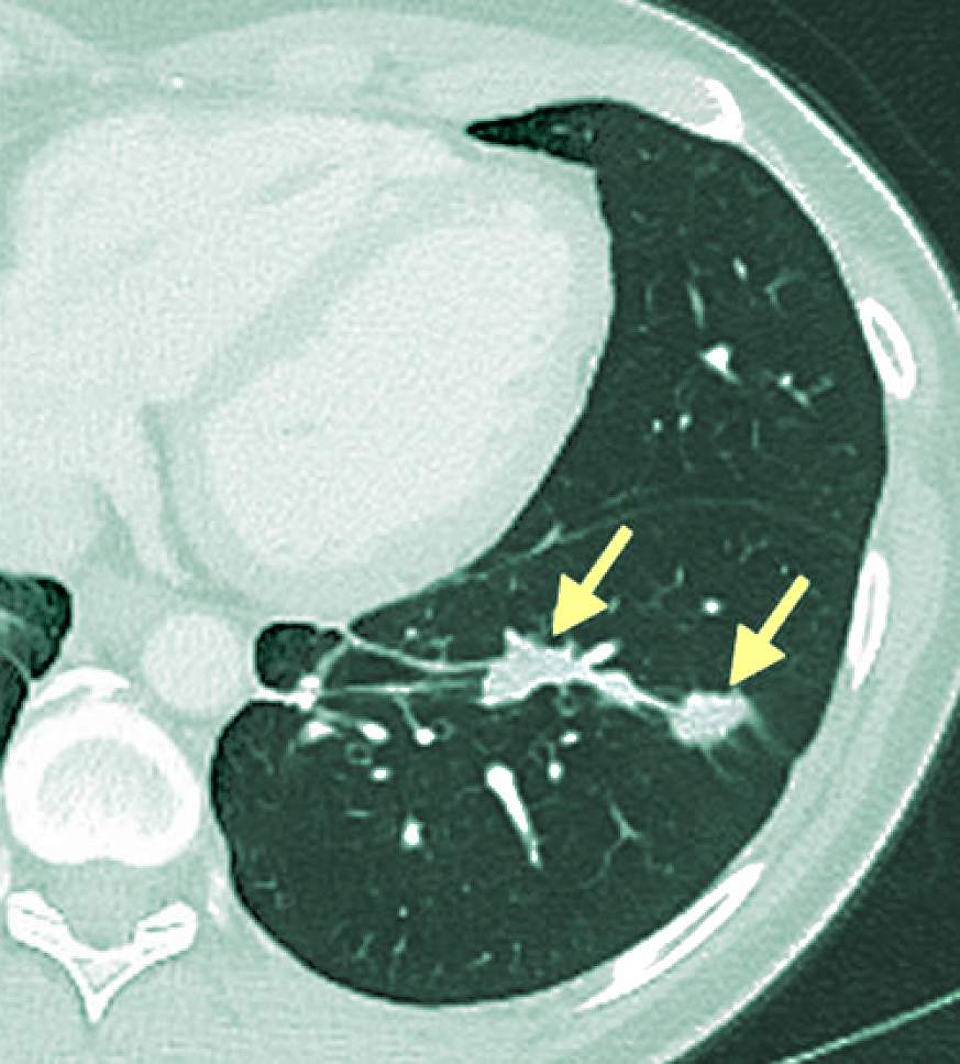 MRI showing tumors.