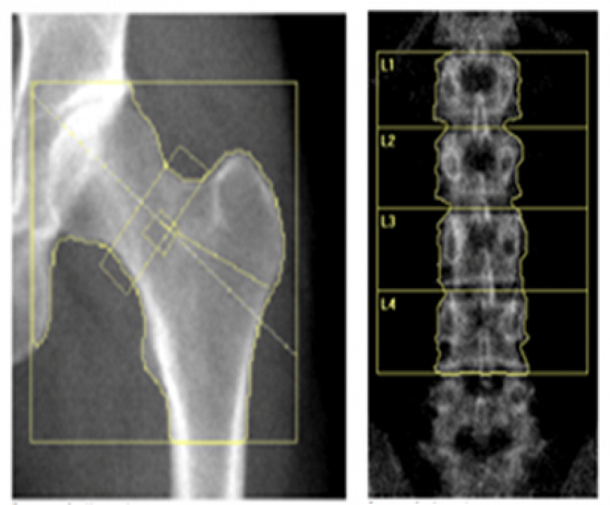 Hormone treatment restores bone density for young women ...