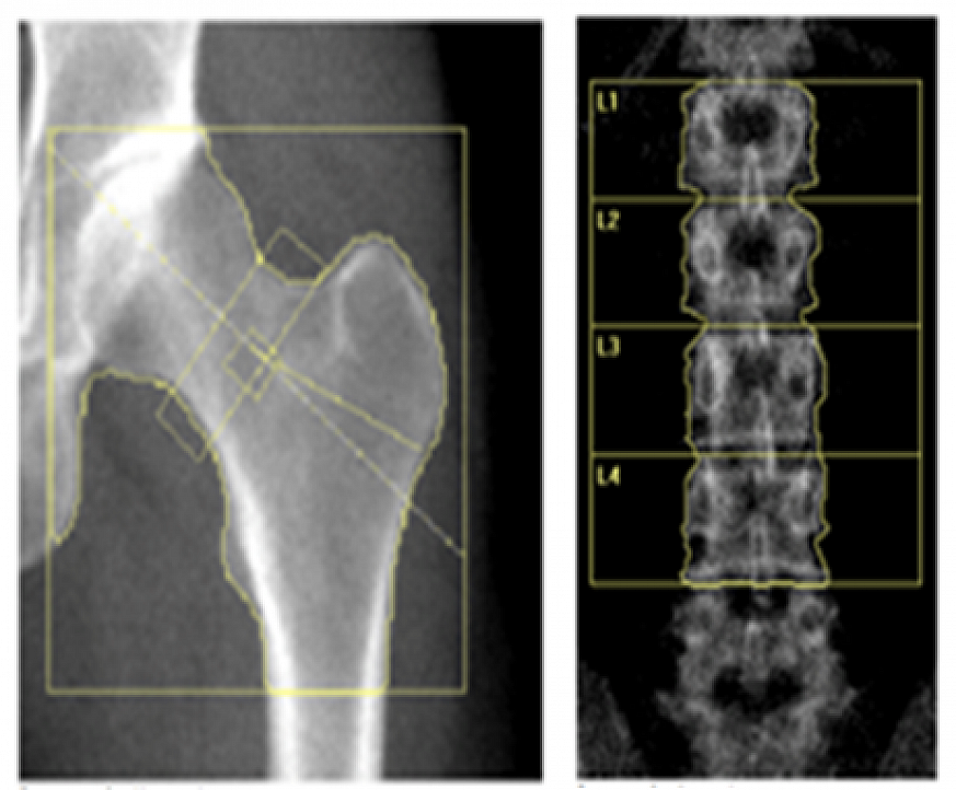Hip and spine xrays.