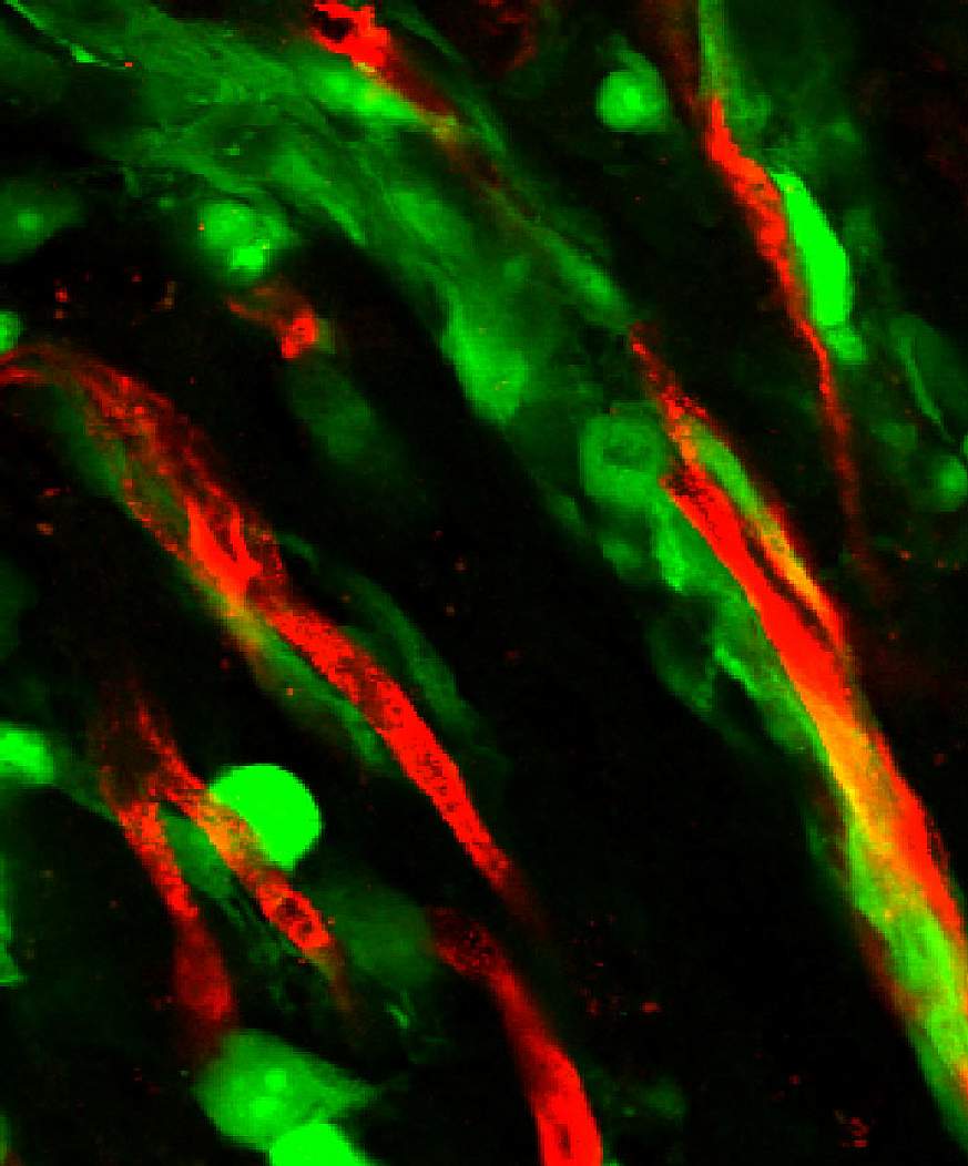 Image of glioma cells