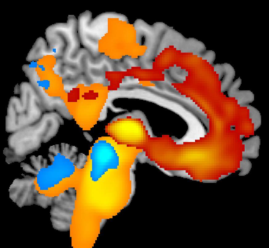Image showing severe brain tissue loss