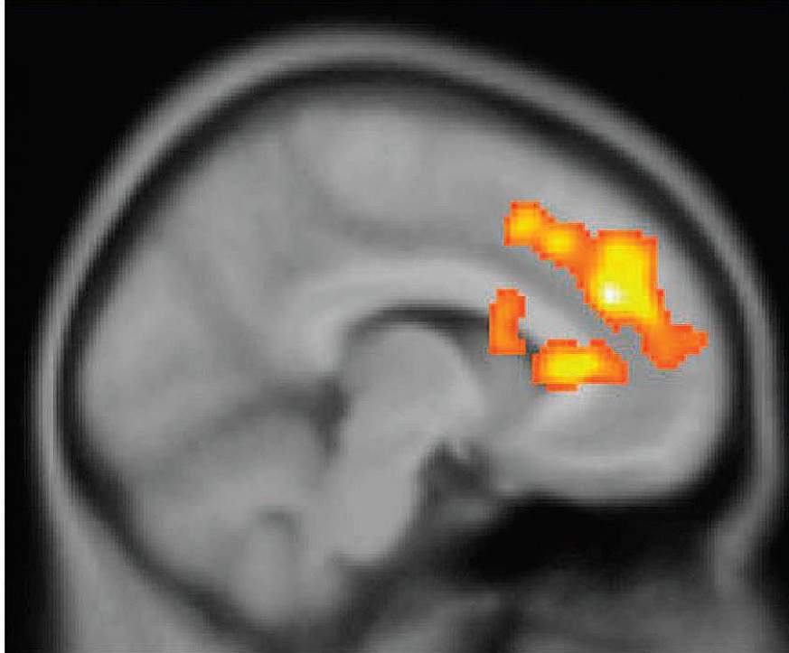 Image of a PET scan