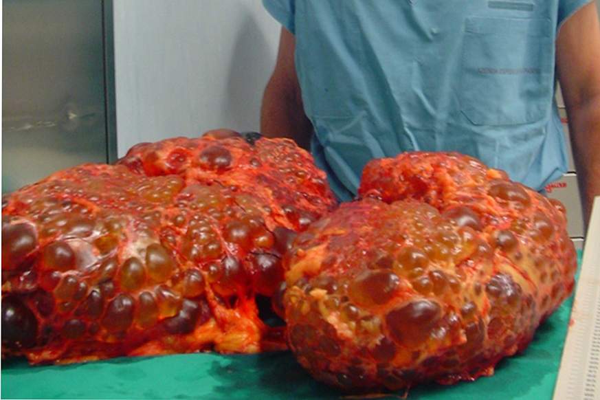 Image of kidneys affected by polycystic kidney disease