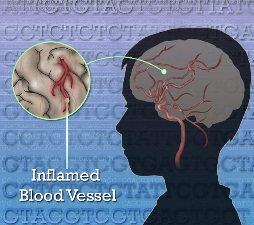 Illustration of an inflamed blood vessel in the brain.
