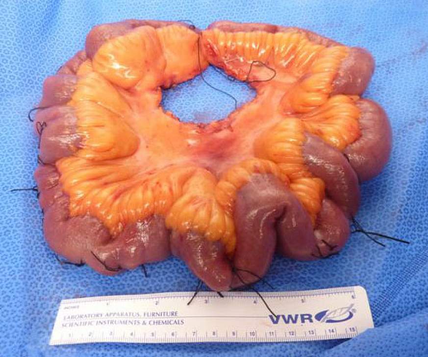 Image of small intestine with tumors