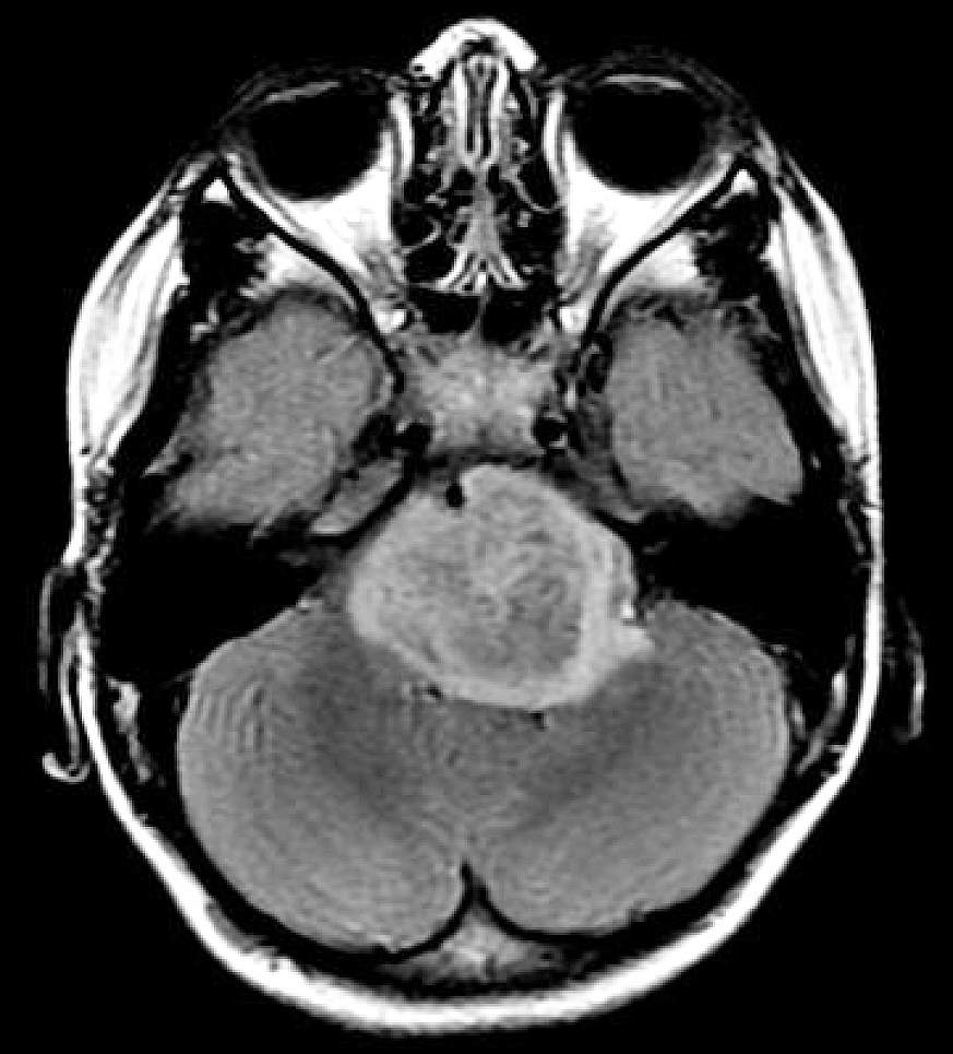 Image of a pediatric brain tumor