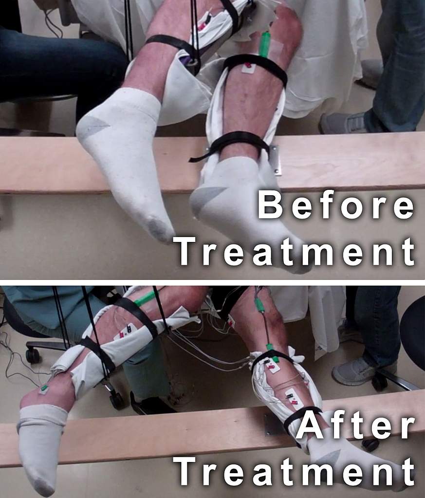 Image showing legs before and after treatment