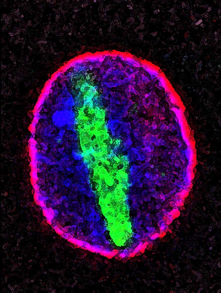Study links ALS and FTD mutation to nuclear transport